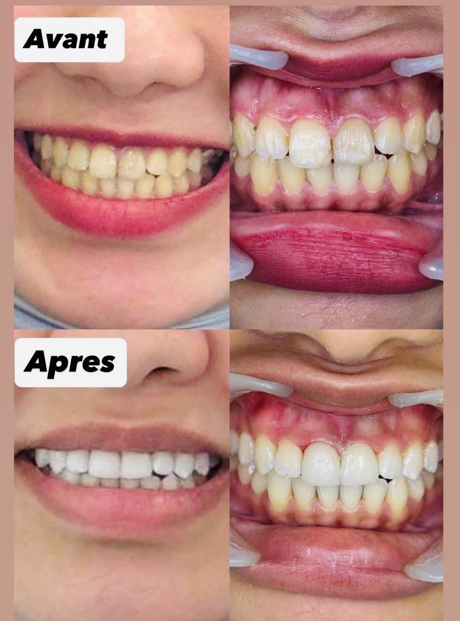 Avant-Après 2